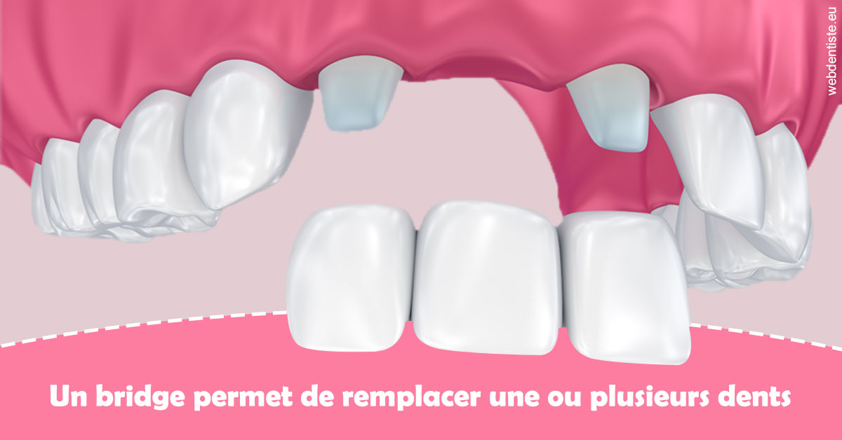 https://www.docteur-pauly-callot.fr/Bridge remplacer dents 2