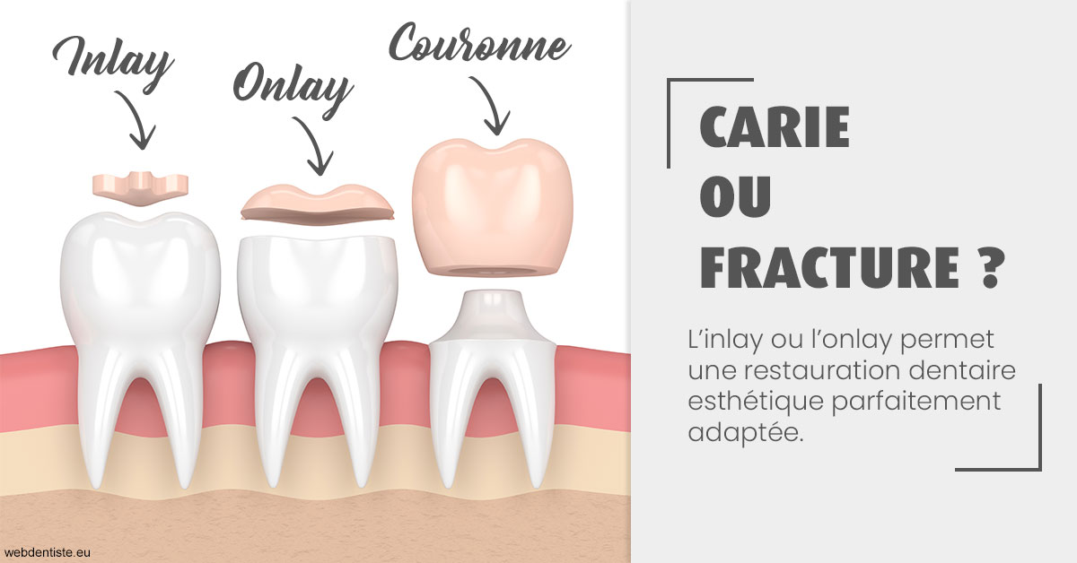 https://www.docteur-pauly-callot.fr/T2 2023 - Carie ou fracture 1