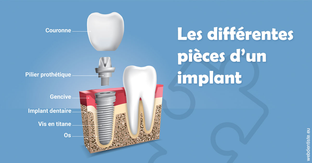 https://www.docteur-pauly-callot.fr/Les différentes pièces d’un implant 1